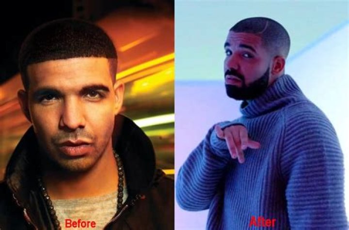 Drake Nose Surgery: Everything You Need To Know