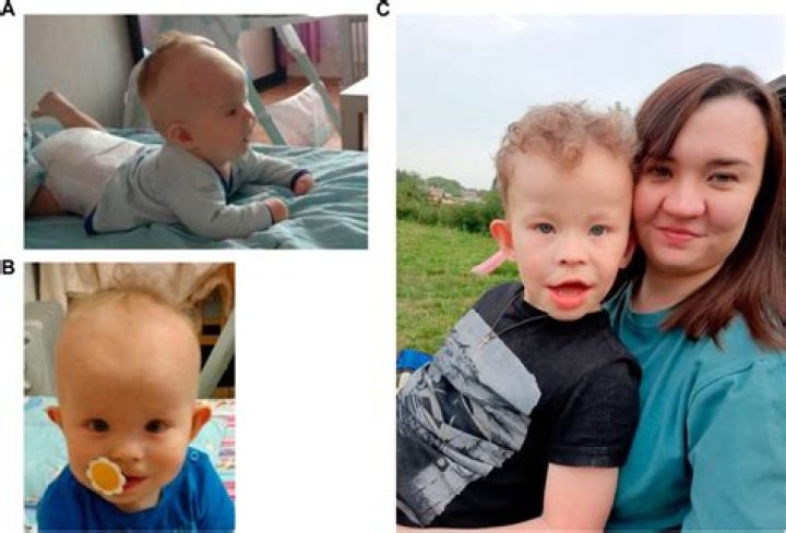 Pallister-W Syndrome: A Comprehensive Guide To Rosas