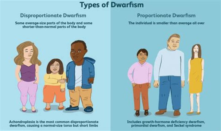 Uncover The Type Of Dwarfism Affecting Hasbulla