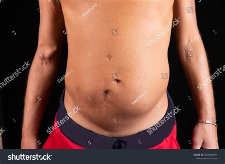 Unveiling The Truth About Kidney Surgery Scars: A Comprehensive Guide